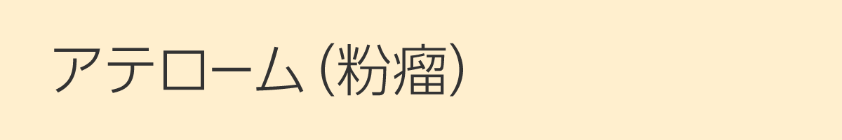 アテローム（粉瘤）